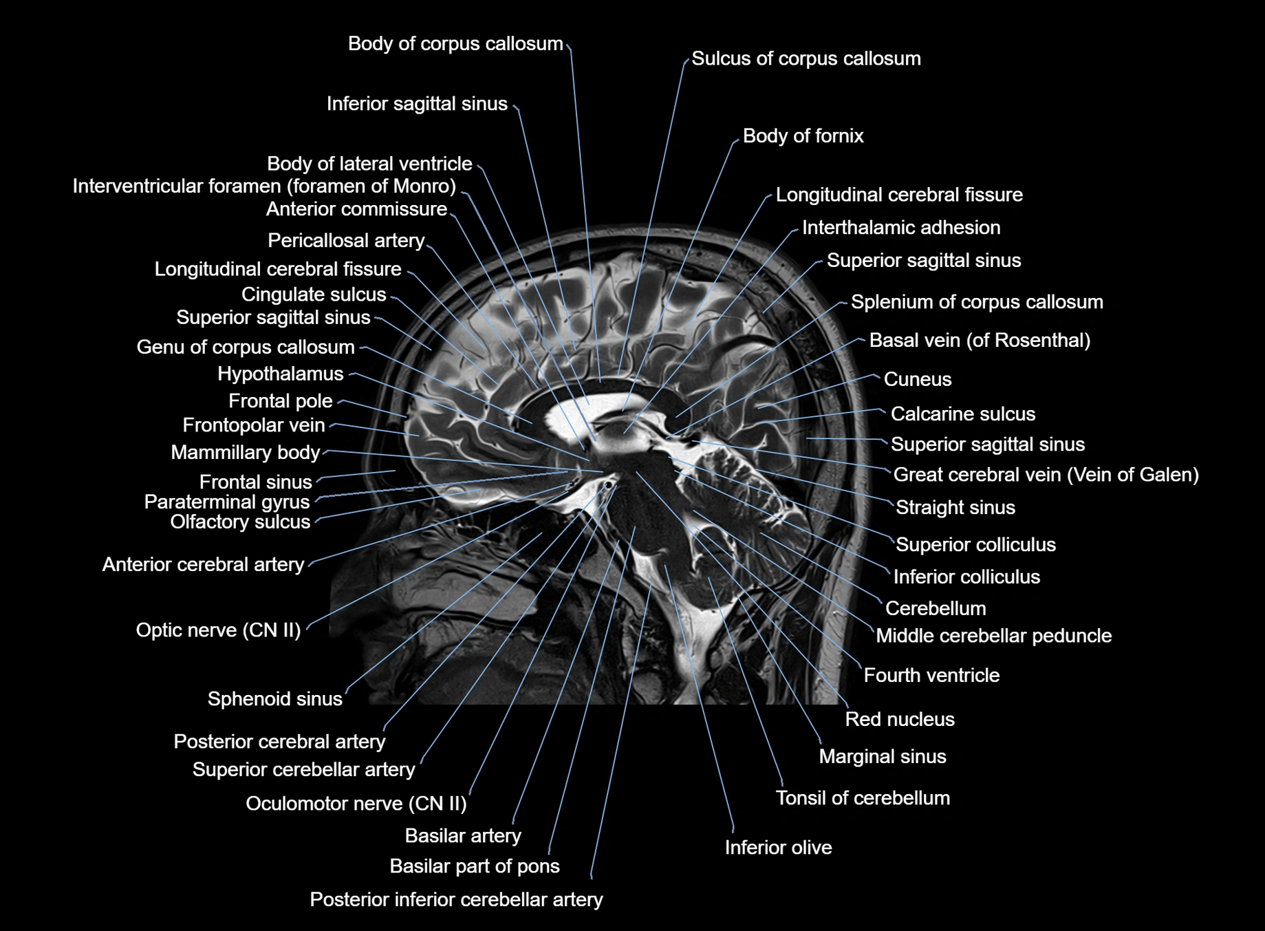brain sagittal anatomy 3T MRI images -img-00001-00032.webp